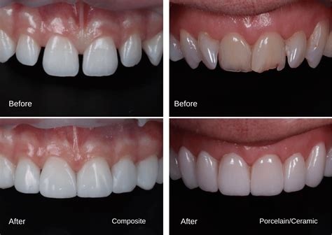 composite veneers how long do they last|Composite Veneers: What You Need To Know – Forbes Health.